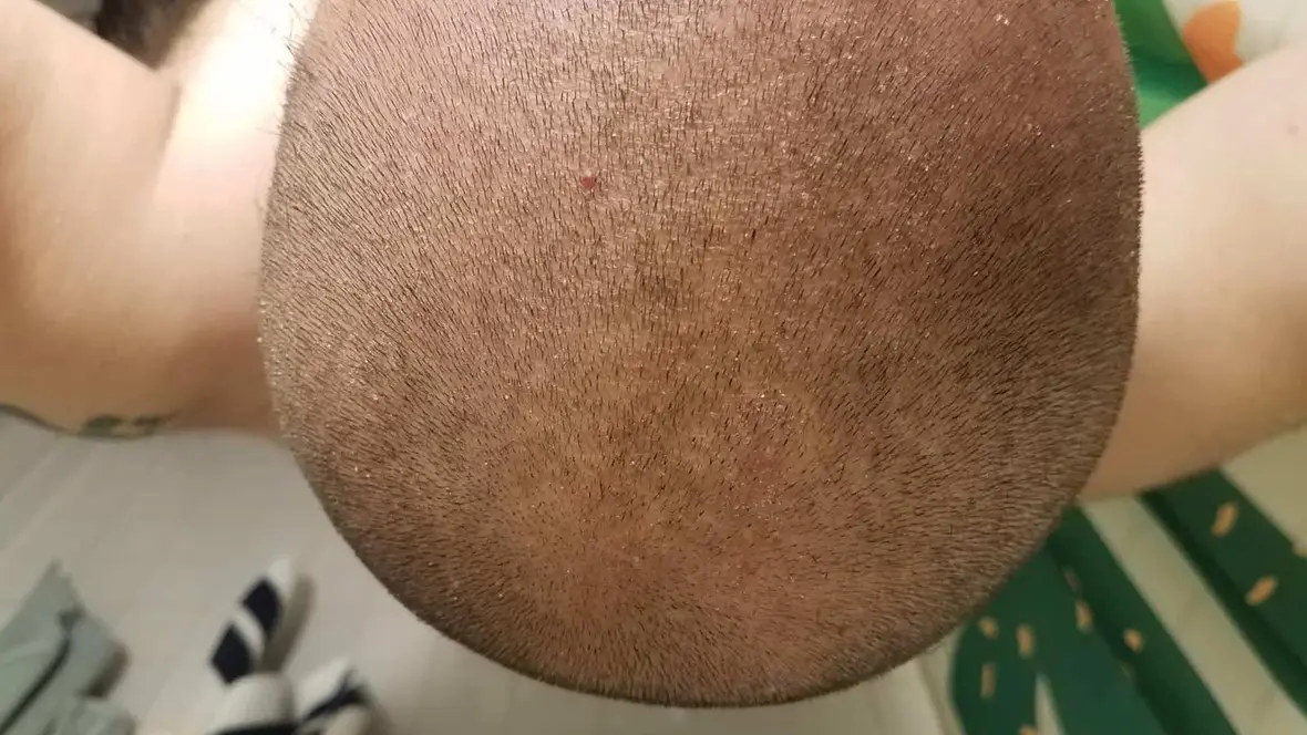 Comment se passe une tricopigmentation ?