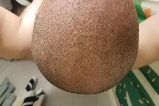 Comment se passe une tricopigmentation ?