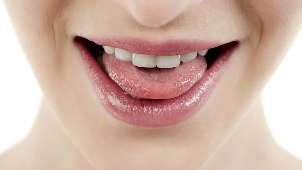 Pourquoi m'arrive-i-il d'avoir la langue blanche ?