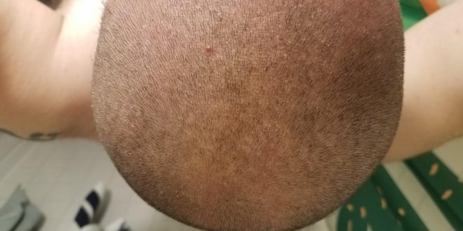 Comment se passe une tricopigmentation ?